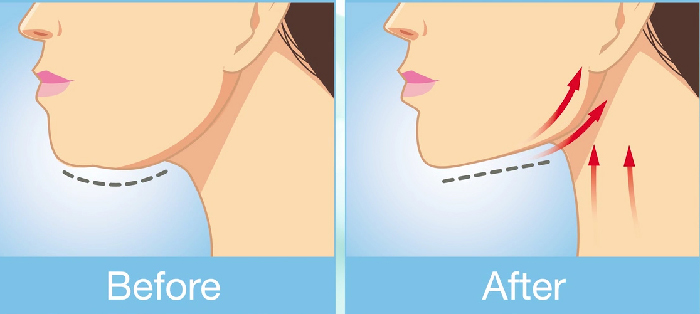 Neck lift before and after.