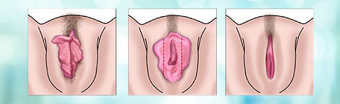 Labiaplasty procedure.