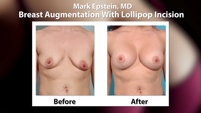 Breast lift before and after.