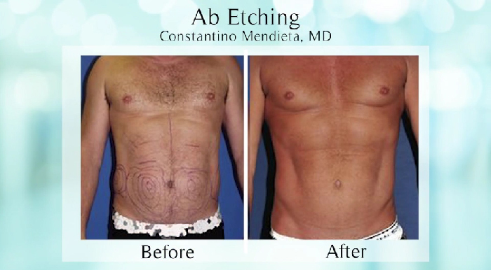 Ab etching before and after.