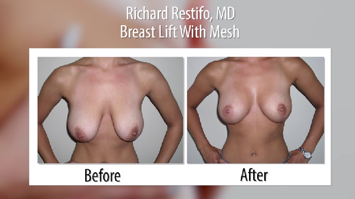 Breast lift with mesh - before and after.