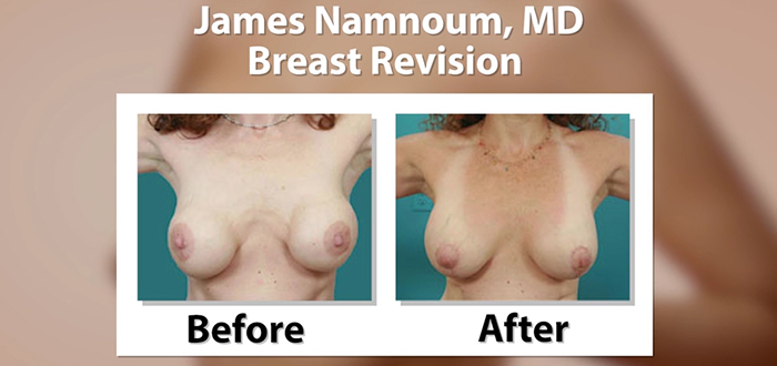 Breast revision before and after.