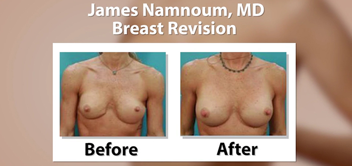James Namnoum - breast revision before and after.