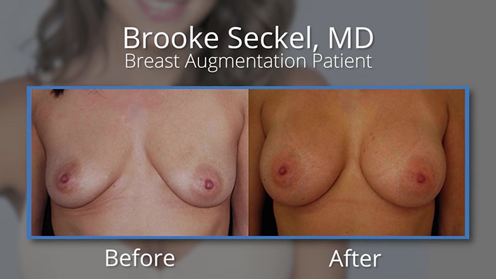Natural breast augmentation before and after.