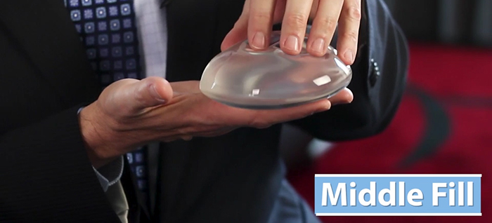 Breast implant cohesiveness - middle fill.