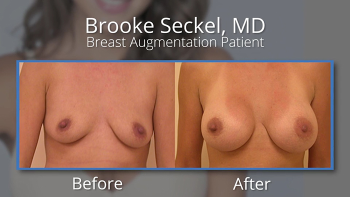 Natural breast augmentation - Dr. Brooke Seckel.