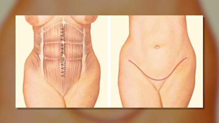 Low scar abdominoplasty results.