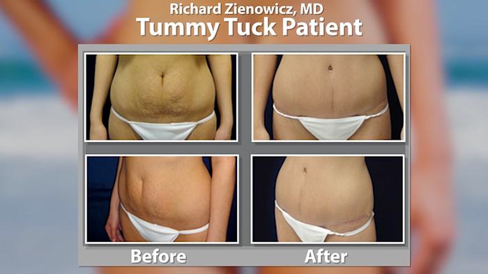 Low scar abdominoplasty before and after.