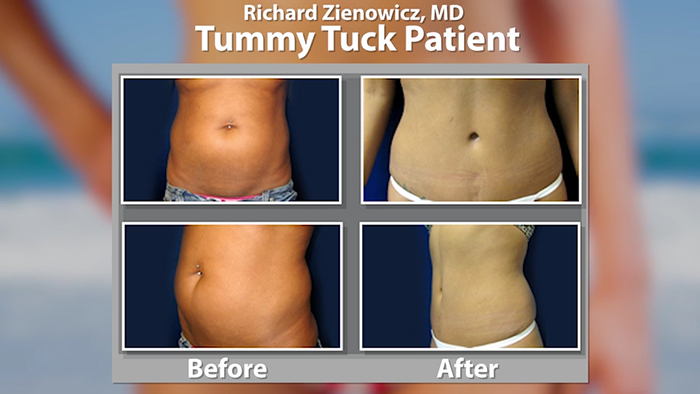 A low scar tummy tuck procedure.