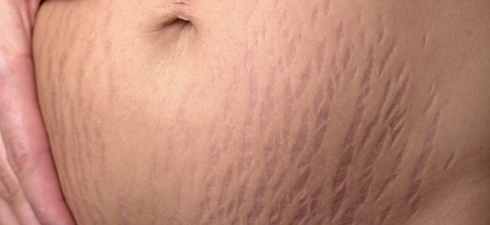 Mommy makeover - stretch marks.