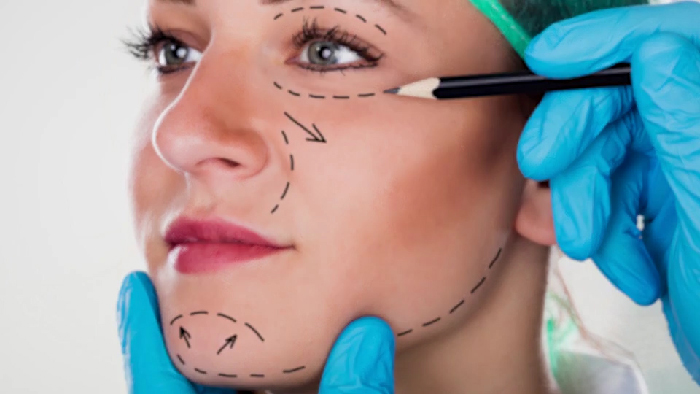 Face lift techniques.