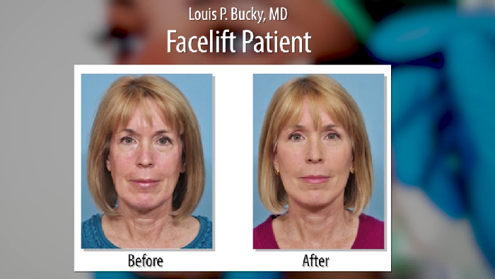 Face lift before and after - Dr. Bucky.