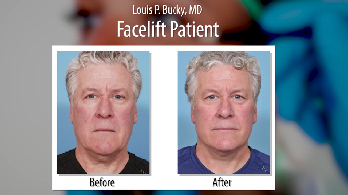 Face lift results.