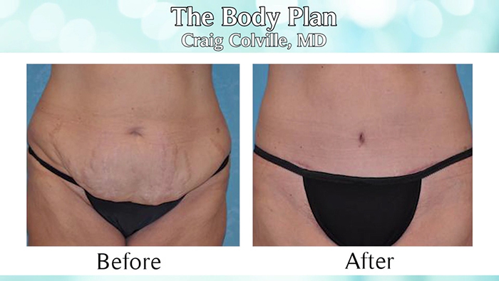 The Body Plan - body contouring.