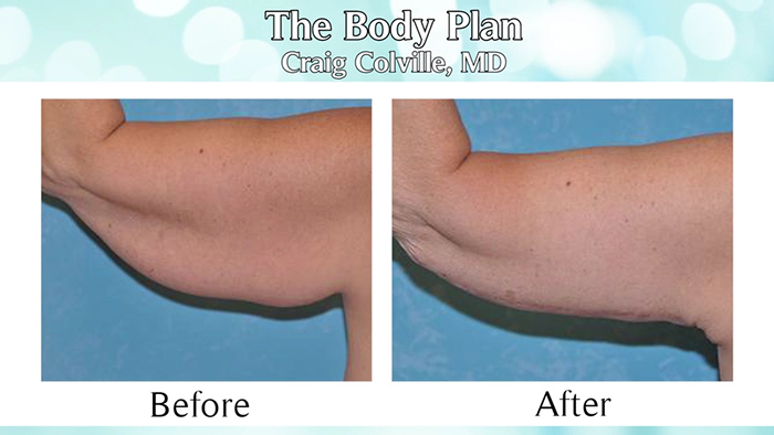 Arm lift with body contouring.