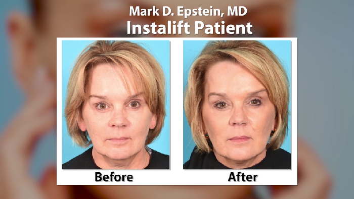 Instalift before and after - Dr. Mark Epstein.