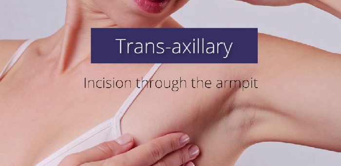 The trans-axillary incision.