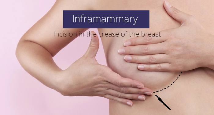 The inframammary approach.