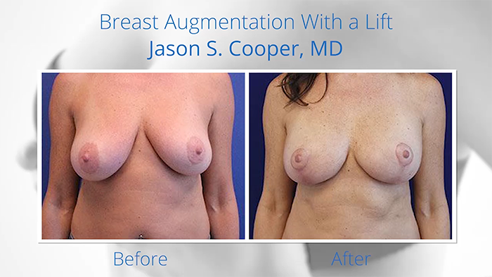 Breast lift - before and after.
