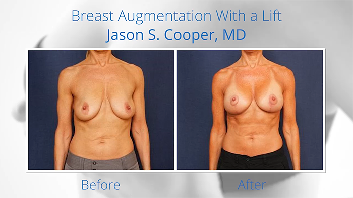 Breast lift with implants - before and after.