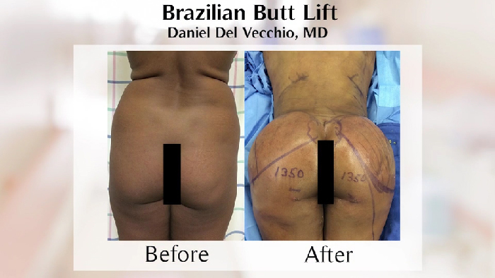 Butt enhancement with fat grafting.
