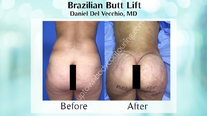 Butt enhancement before and after.
