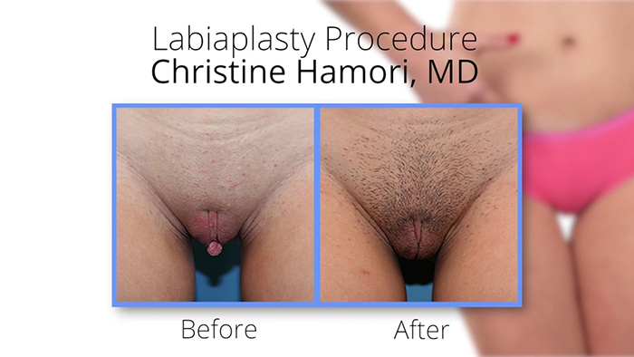 Vaginal rejuvenation - Dr. Hamori before and after.