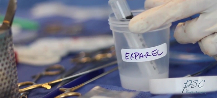 Exparel for pain-free, drainless tummy tuck.