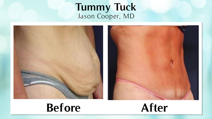 Full tummy tuck results.