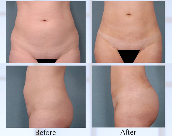 Liposculpture before and after.