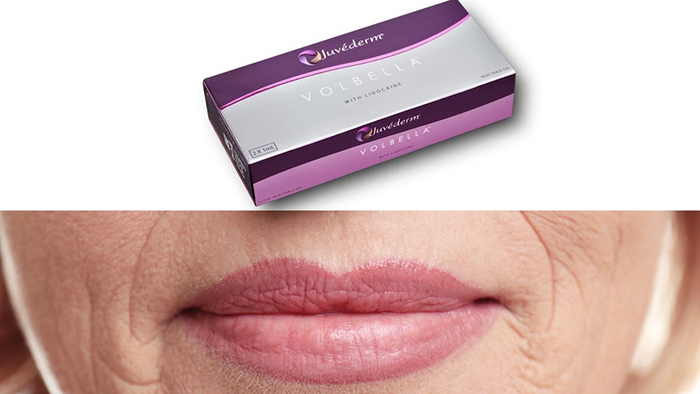 Volbella, the newest of the lip fillers.