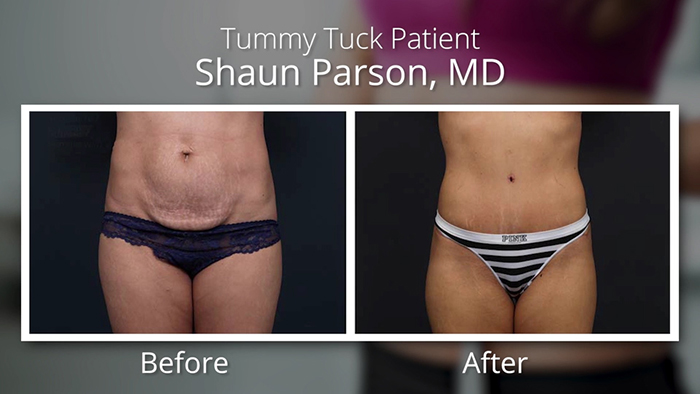 Tummy tuck before and after.