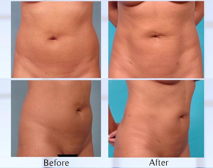 Liposculpture - Epstein before and after.