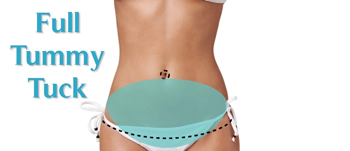 Full tummy tuck.