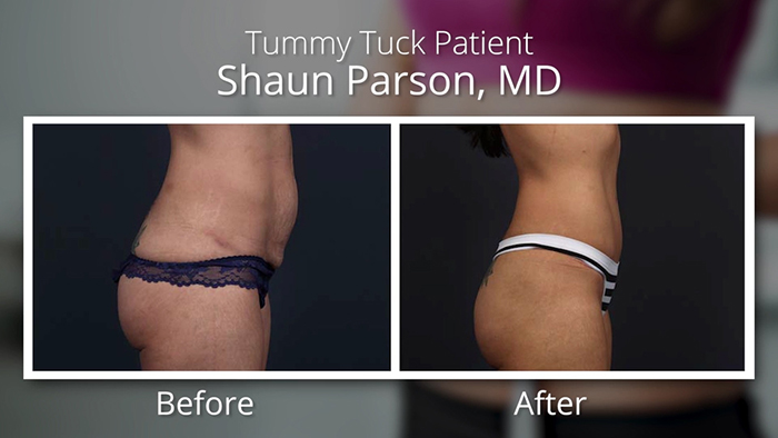 Tummy tuck results - Dr. Parson.
