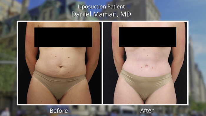 Lipo for fit bodies - Dr. Maman before and after.