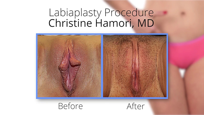 Vaginal rejuvenation - before and after.