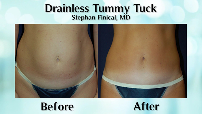 Drainless tummy tuck results.
