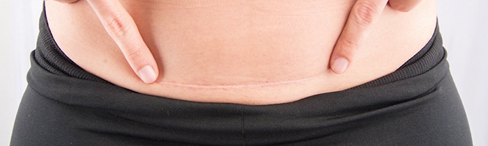 Tummy tuck scars.