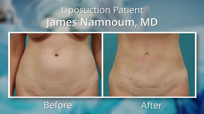 Liposuction on fit patients - before and after.