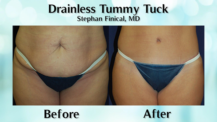 Drainless tummy tuck before and after.