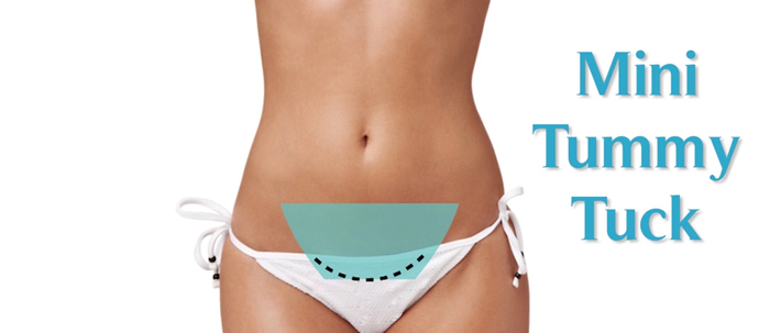 Mini tummy tuck.