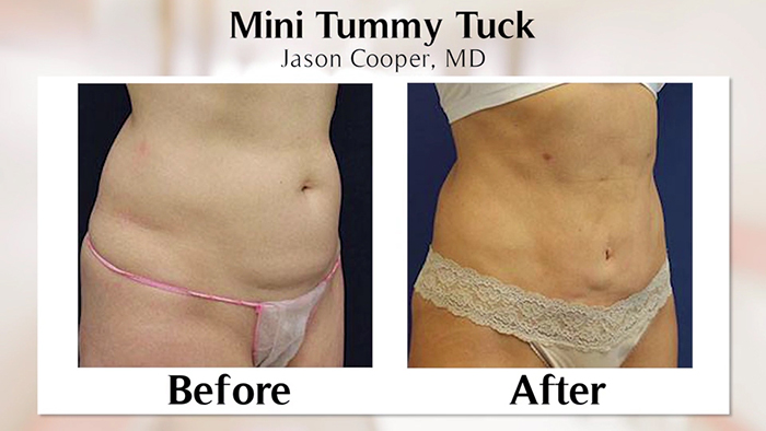 Mini tummy tuck results.