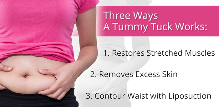 How a tummy tuck works.