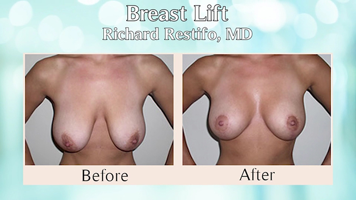Breast revision before and after.