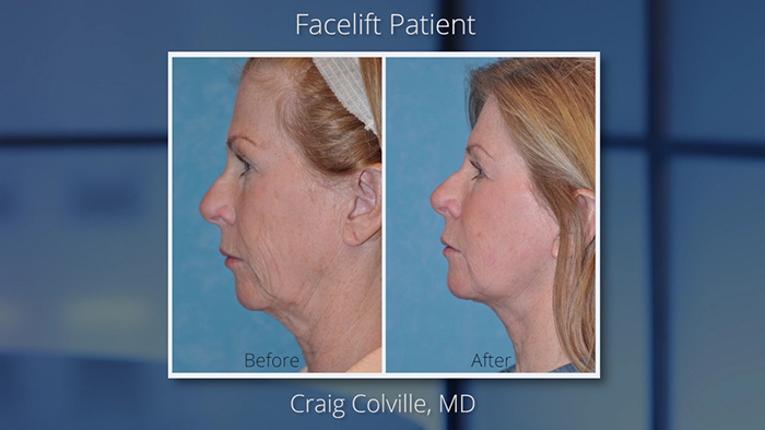 The face plan - before and after.