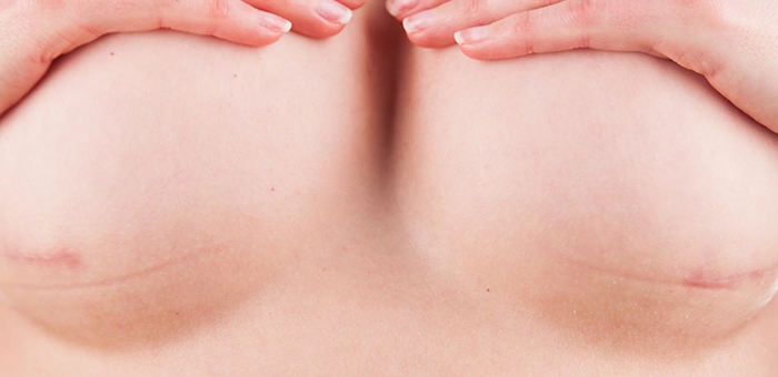 Breast lift scars on breast.