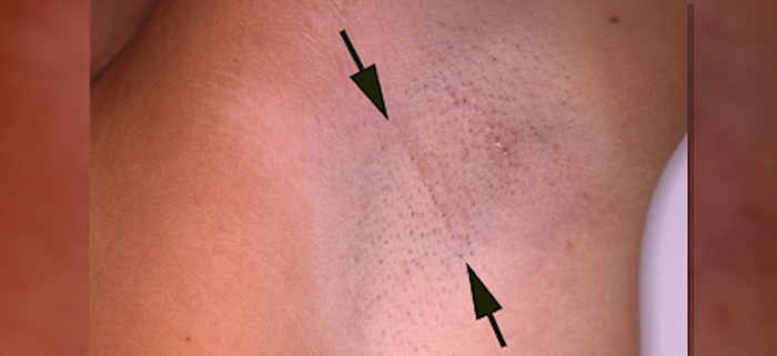 Transaxillary augmentation scars.