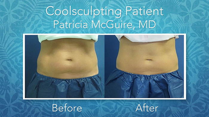CoolSculpting before and after - Dr. Pat McGuire.