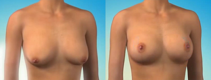 Breast surgery revision results.